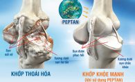 Xương chắc khỏe