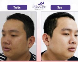 San bằng sẹo rỗ bằng phương pháp laser không xâm lấn từ TMV Ngọc Diệp