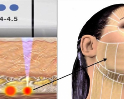 TMV NGỌC DIỆP RA MẮT CÔNG NGHỆ ULTHERAPY CHÍNH HÃNG MỸ – XÓA BỎ MỌI NẾP NHĂN