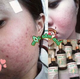Trị sạch tất cả các loại mụn mộc sâm anh