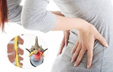 Chèn ép rễ thần kinh do thoát vị đĩa đệm lưng: Nguyên nhân – Biến chứng – Dấu hiệu