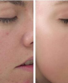 Peel là gì? Sử dụng peel da có mang lại vẻ đẹp không tì vết?