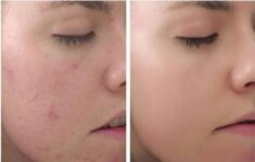 “Peel là gì? Sử dụng peel da có mang lại vẻ đẹp không tì vết?