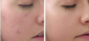 Peel là gì? Sử dụng peel da có mang lại vẻ đẹp không tì vết?