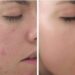 Peel là gì? Sử dụng peel da có mang lại vẻ đẹp không tì vết?