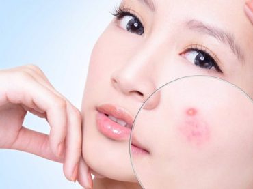 Trị mụn ngày đèn đỏ không khó khi đã có tuyệt chiêu sau
