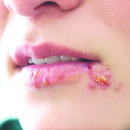 Bệnh Herpes Có Nguy Hiểm Không? Cách Chữa Trị Herpes