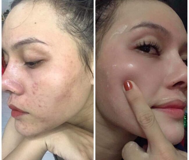 [[[Hot]]] Vấn đề bong da khi dùng serum thay da nhân MQSkin