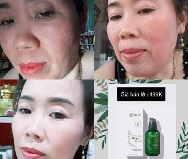 TRONG KHI SỬ DỤNG SERUM THAY DA NHÂN SÂM MQSKIN DA SẼ CÓ NHỮNG BIỂU HI