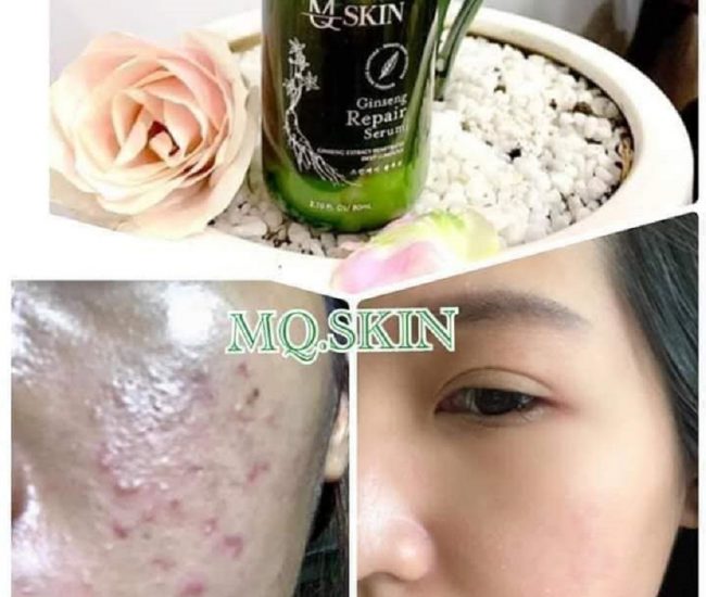 Phản Hồi Serum Thay Da Nhân Sâm Mqskin. Bạn nên xem trước khi mua!!