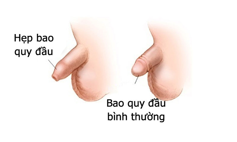 Hẹp bao quy đầu ở trẻ em cần điều trị như thế nào?