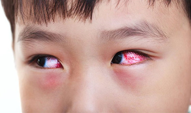 Phòng tránh viêm kết mạc khi giao mùa