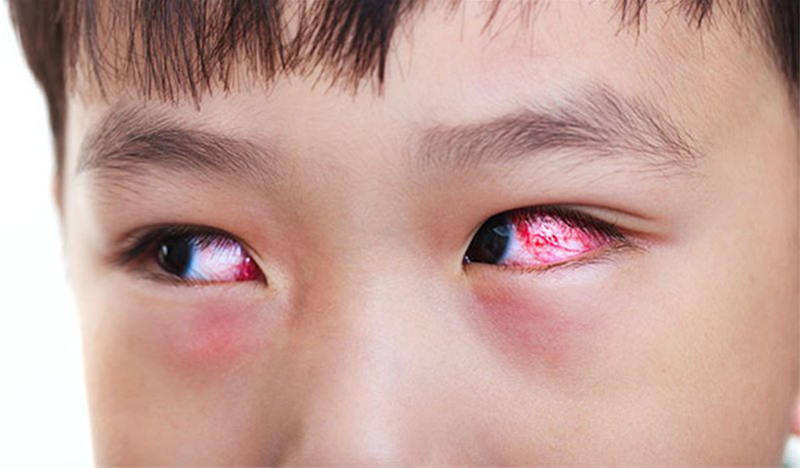 Phòng tránh viêm kết mạc khi giao mùa
