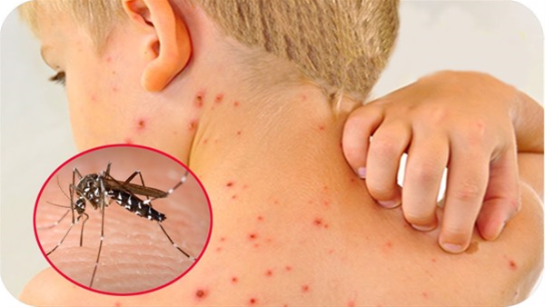 Sốt xuất huyết ở trẻ và những điều cha mẹ cần lưu ý