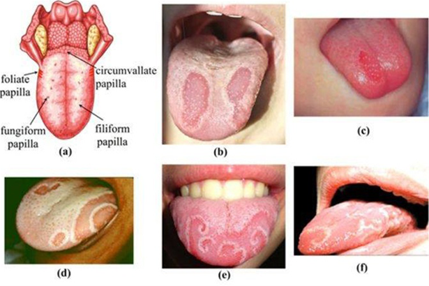 Viêm lưỡi bản đồ ở trẻ em có nguy hiểm không?