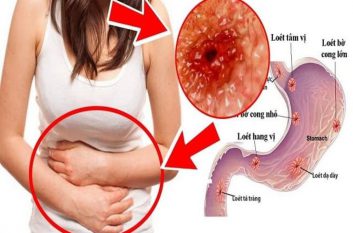 Những thói quen tưởng chừng như vô hại nhưng lại làm “tổn thương” đến dạ dày