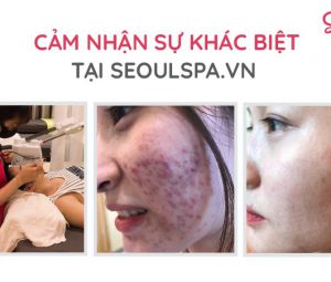 Trị Mụn Y Khoa