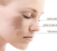 Kem trị nám 14 ngày với peptide làm trắng thế hệ mới, kích hoạt bốn cơ chế trị nám da