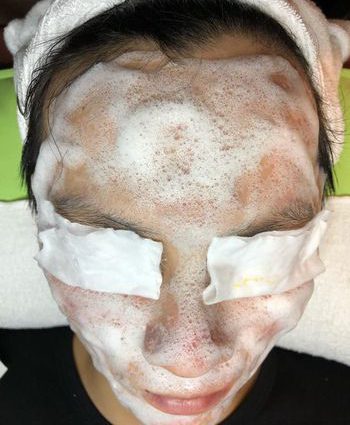 Liệu Trình Carboxyl Thải Độc Da