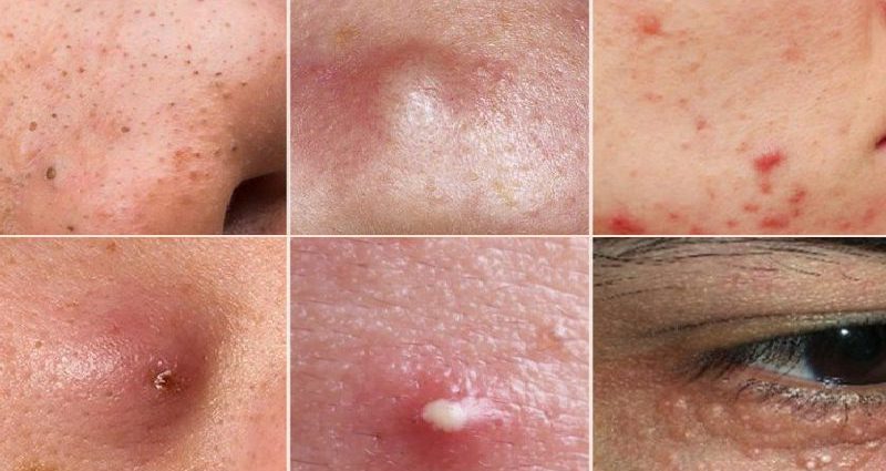 Điều trị da mụn