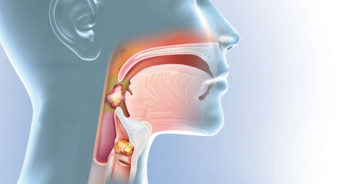 Tại sao tầm soát ung thư vòm họng là cách ngăn ngừa bệnh ung thư tốt nhất hiện nay