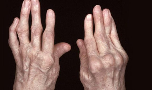 4 hậu quả khôn lường nếu không sớm điều trị viêm đa khớp