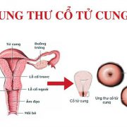 Ung thư vú và cổ tử cung