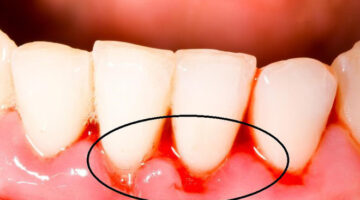 Bệnh răng miệng và những cảnh báo nguy hiểm về sức khỏe